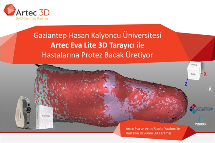 Gaziantep Hasan Kalyoncu Üniversitesi Artec Eva Lite 3D Tarayıcı İle Hastalarına Protez Bacak Üretiyor